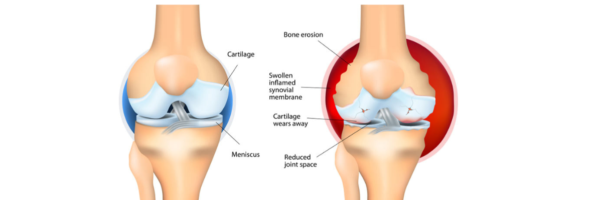 Rheumatoid Arthritis Awareness
